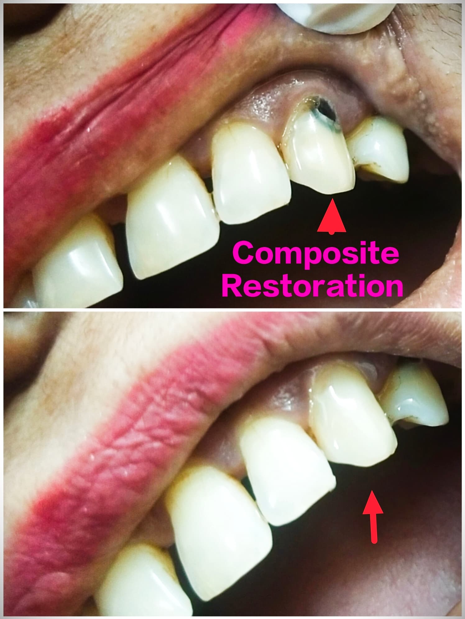 Restoration - Composite Filling
