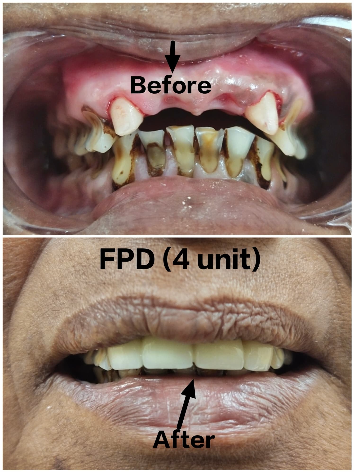 Fixed Partial Denture