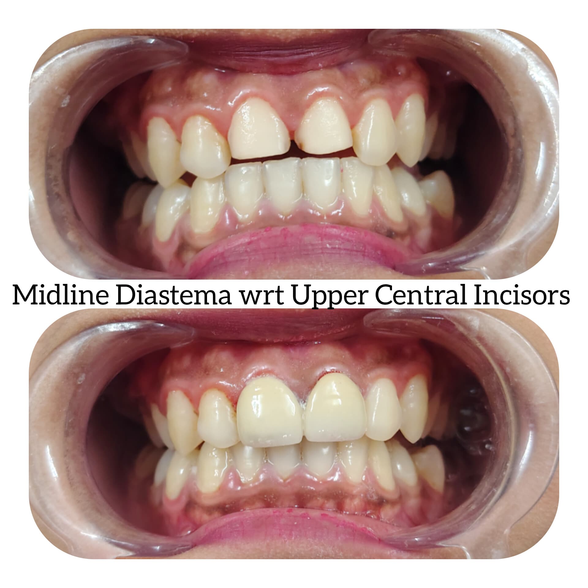 Midline Diastema Correction