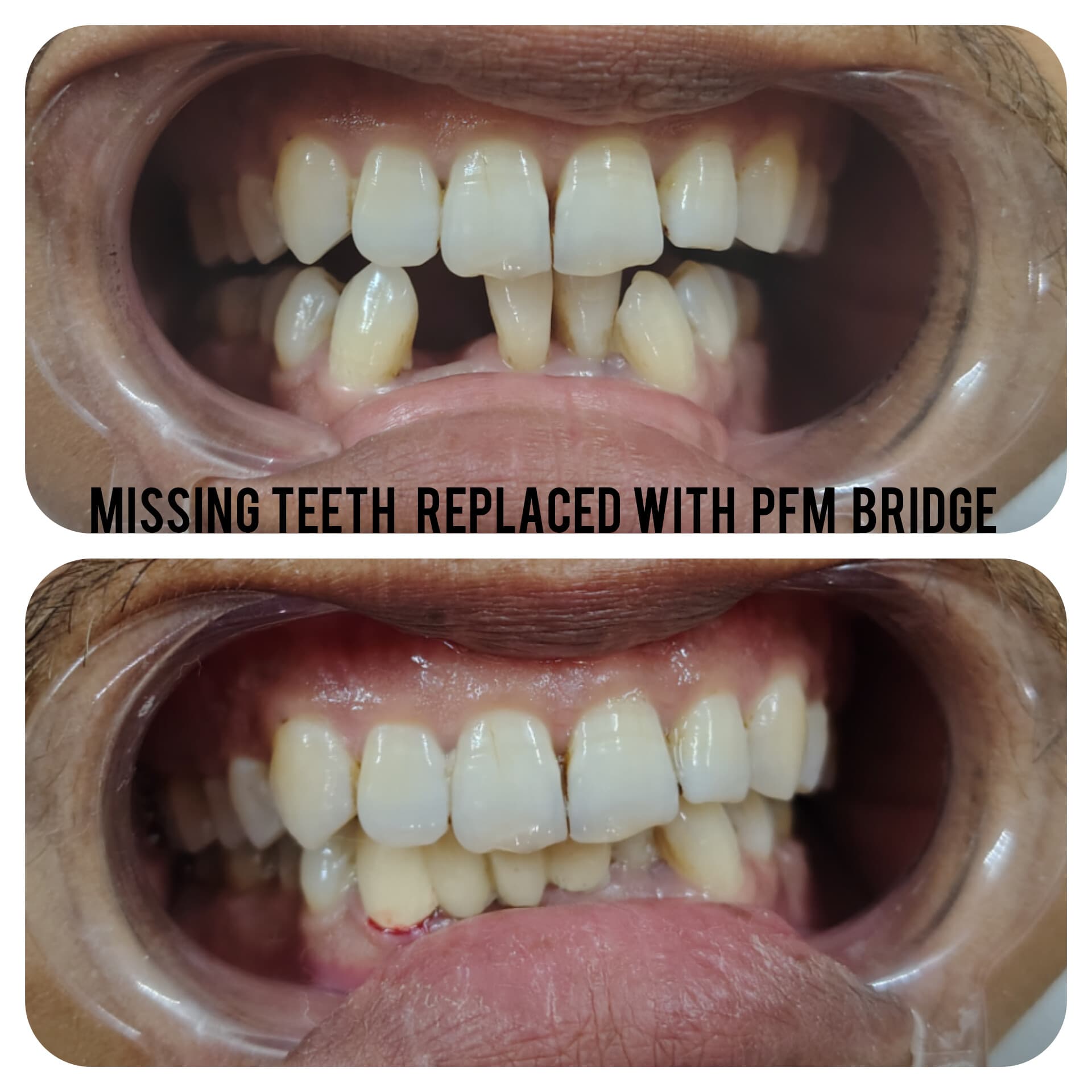 Missing Tooth Replacement