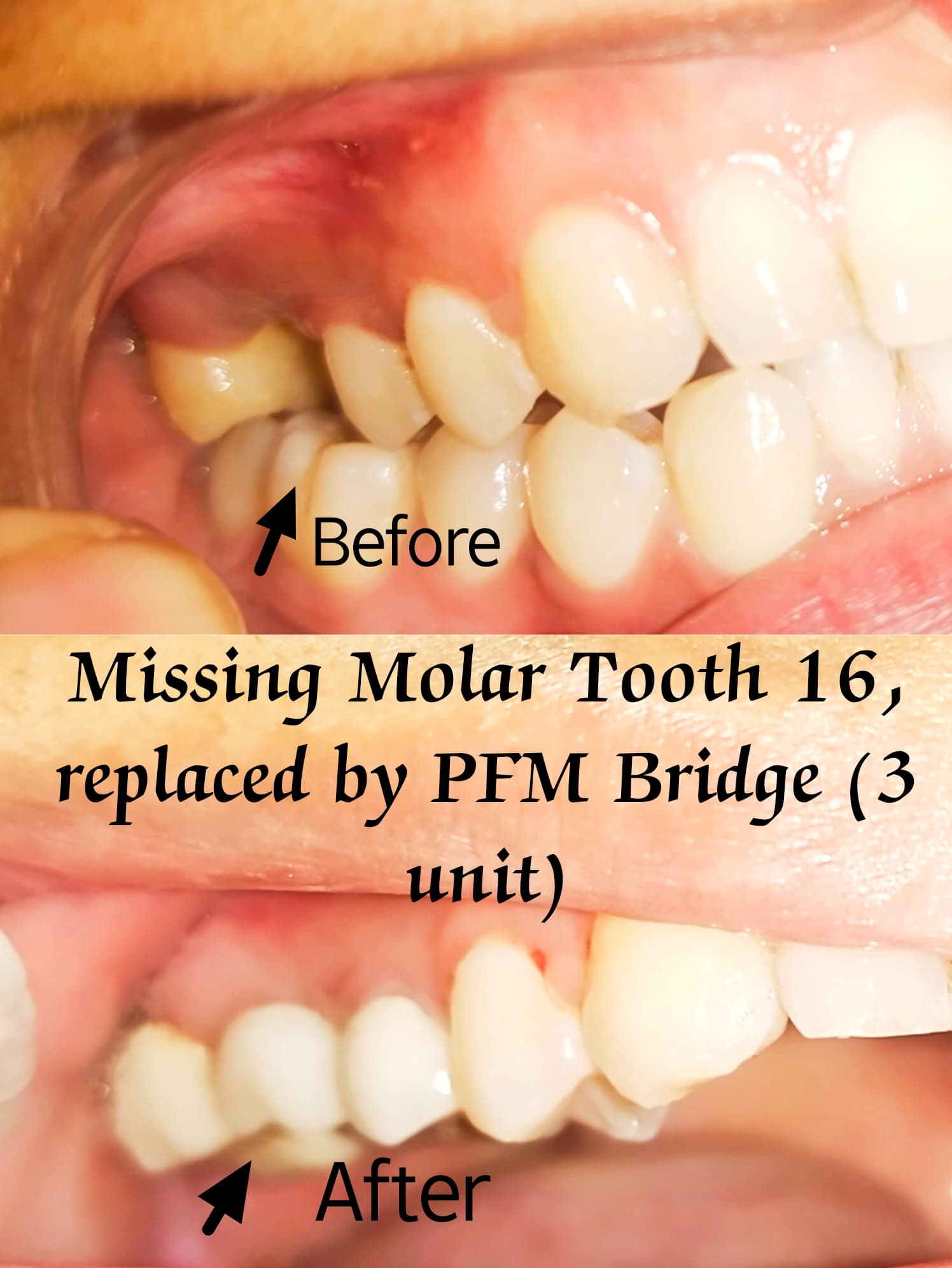 Porcelain-Fused-to-Metal (PFM) dental bridge
