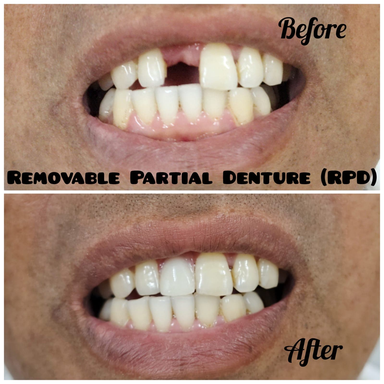 Removabale Partial Denture (RPD) - Before & After
