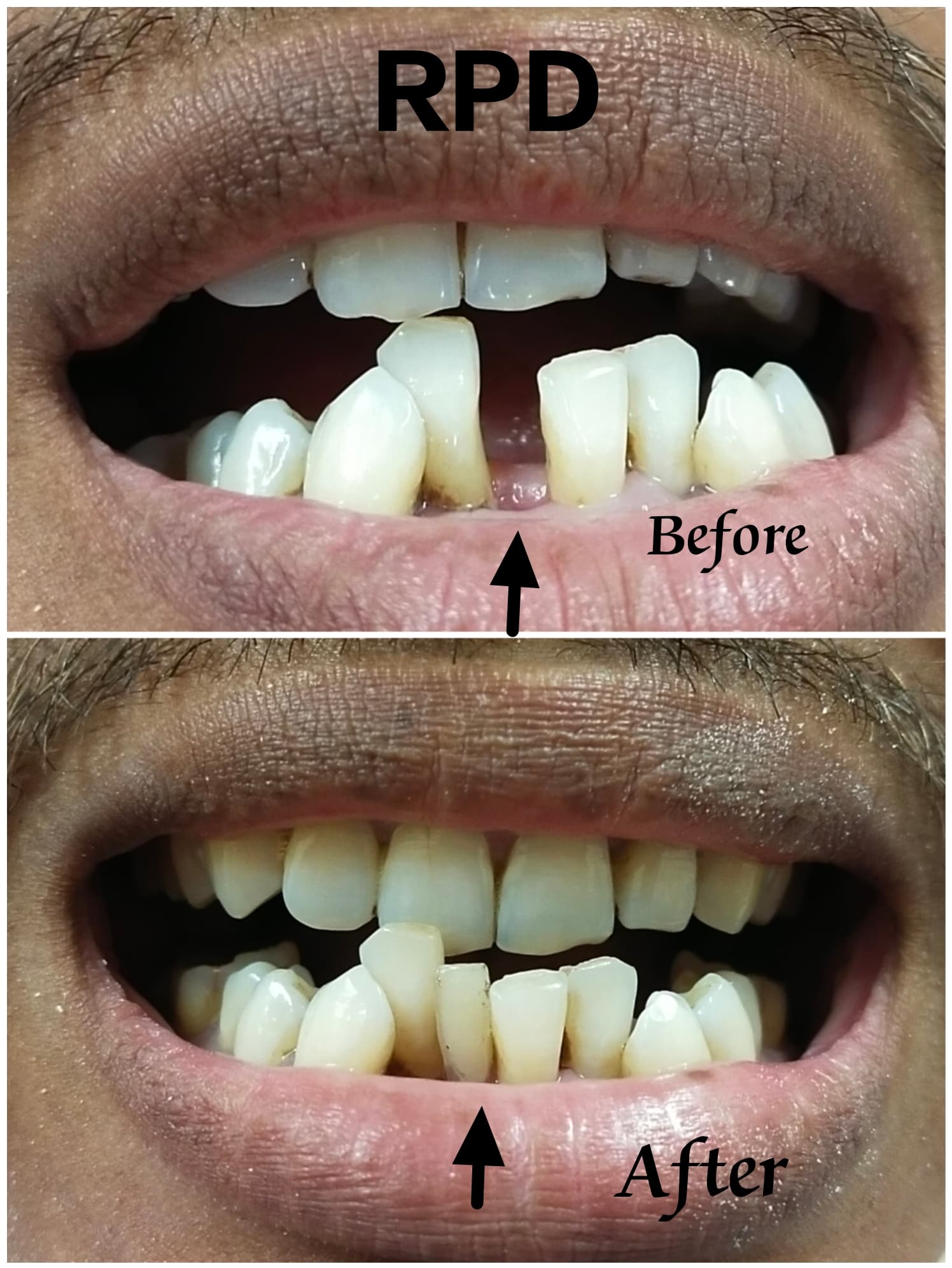 Removabale Partial Denture (RPD) - Before & After