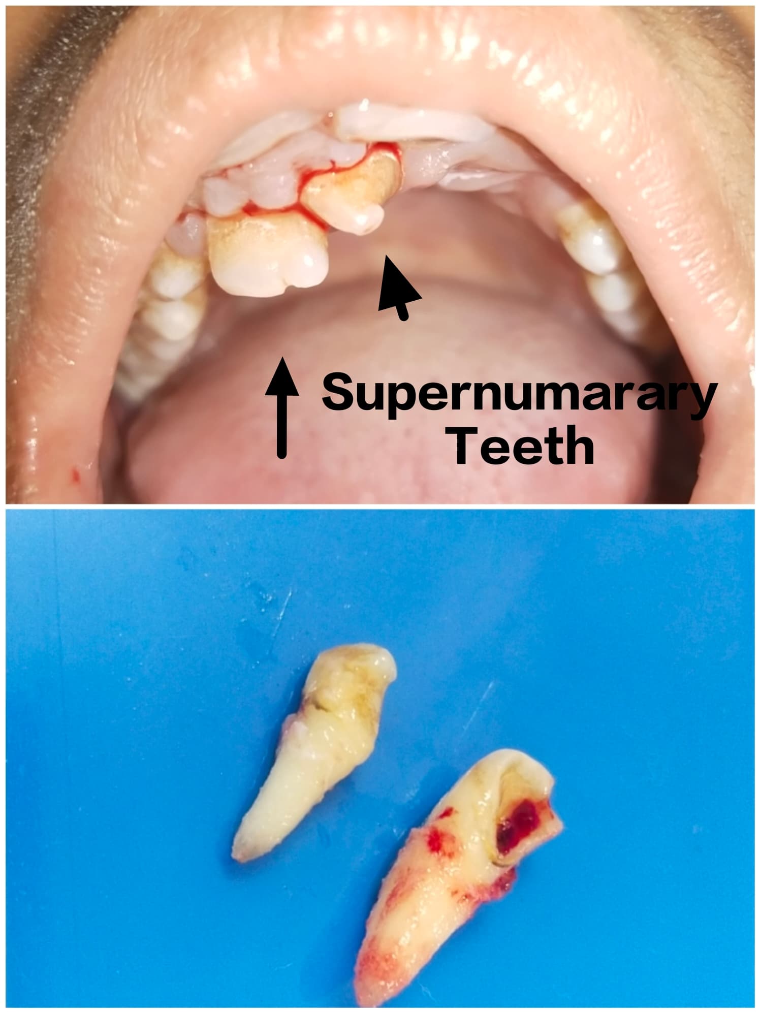 Supernumerary Teeth Removal